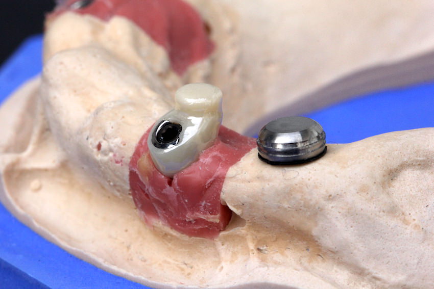 Implantat